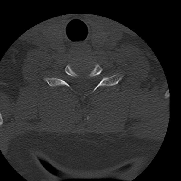 File:Occipital condyle fracture (Radiopaedia 31755-32691 Axial bone window 63).jpg