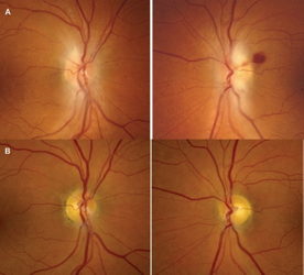 a) On initial presentation, both optic nerves had pale blurring of the disc margins superiorly and inferiorly, with peripapillary hemorrhage in the left eye. b) After thiamine tratment, one month later, the swelling had resolved, with only mild prominence of the retinal nerve fiber layer remaining bilaterally.