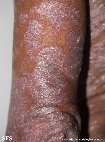 File:Psoriasis (Dermatology Atlas 109).jpg
