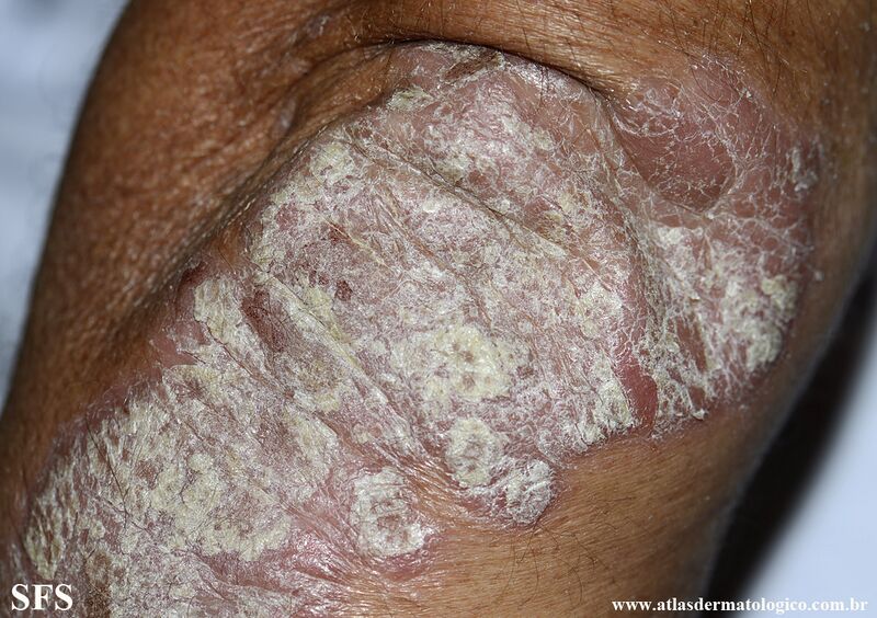 File:Psoriasis (Dermatology Atlas 160).jpg