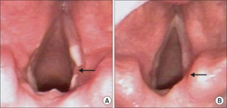 Vocal cord ulcer