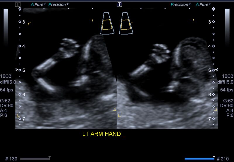 File:1st trimester nuchal-morphology ultrasound (Radiopaedia 44706-48477 General anatomy and NT 31).jpg