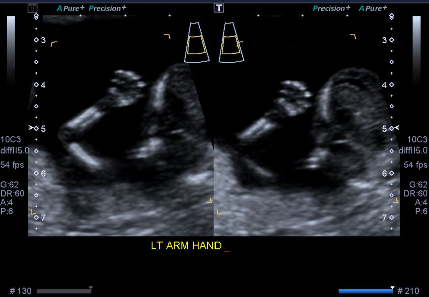 1st trimester nuchal-morphology ultrasound (Radiopaedia 44706-48477 General anatomy and NT 31).jpg