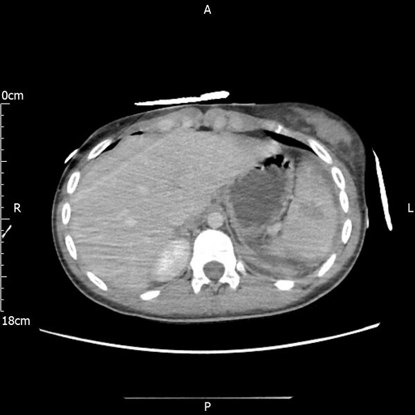 File:AAST grade IV kidney injury with CEUS follow-up (Radiopaedia 72353-82877 Axial C+ portal venous phase 12).jpg