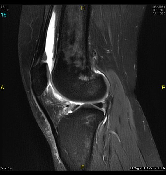 File:ACL mucoid degeration with cystic changes (Radiopaedia 48428-53341 Sagittal PD fat sat 14).jpg