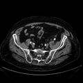 Abdominal aortic aneurysm (Radiopaedia 25855-26001 Axial C+ arterial phase 105).jpg