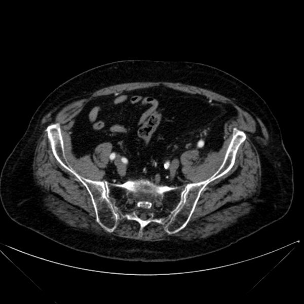 File:Abdominal aortic aneurysm (Radiopaedia 25855-26001 Axial C+ arterial phase 105).jpg