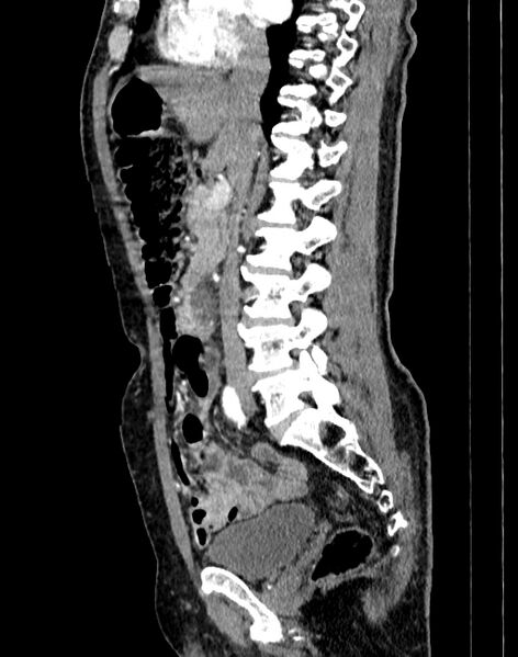 File:Abdominal aortic aneurysm (Radiopaedia 83581-98689 Sagittal C+ arterial phase 31).jpg