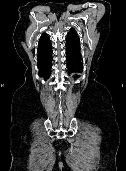 File:Abdominal aortic aneurysm (Radiopaedia 85063-100606 Coronal C+ arterial phase 54).jpg