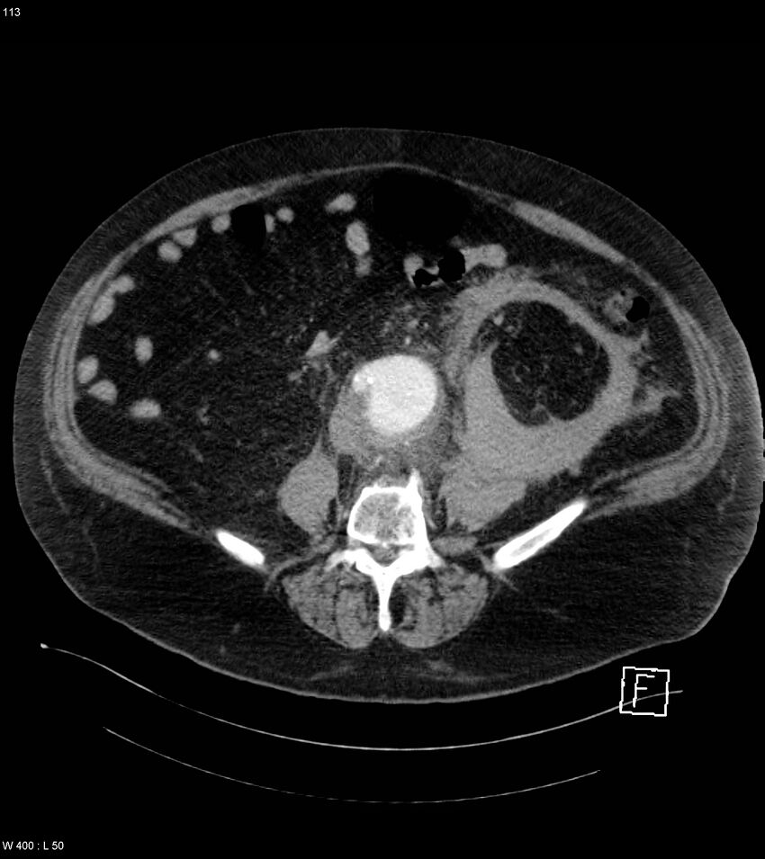 Abdominal aortic aneurysm with intramural hematoma then rupture (Radiopaedia 50278-55632 Axial C+ arterial phase 112).jpg