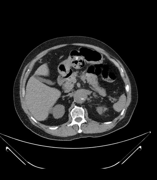 File:Abdominal aortic aneurysm with thrombus fissuration (Radiopaedia 46218-50618 Axial non-contrast 16).jpg