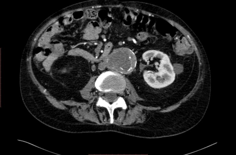 File:Abdominal aortic interposition tube graft and aneurysm thrombosis (Radiopaedia 71438-81857 Axial C+ arterial phase 82).jpg