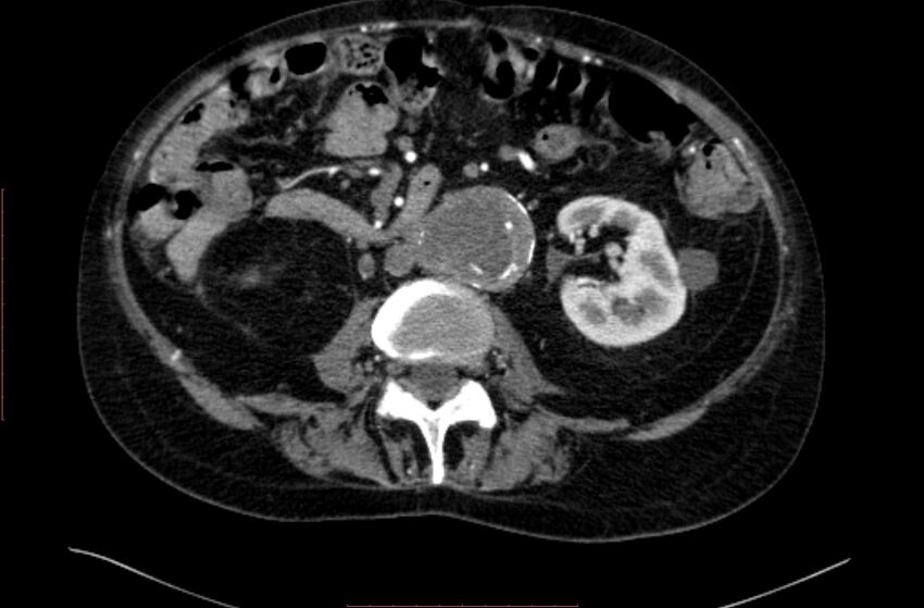 Abdominal aortic interposition tube graft and aneurysm thrombosis (Radiopaedia 71438-81857 Axial C+ arterial phase 82).jpg