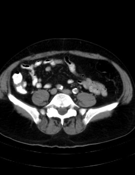 File:Abdominal lymphoma - with sandwich sign (Radiopaedia 53486-59492 Axial C+ portal venous phase 34).jpg