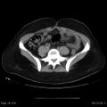 Abdominal wall endometriosis (Radiopaedia 25723-25885 Axial C+ portal venous phase 24).jpg