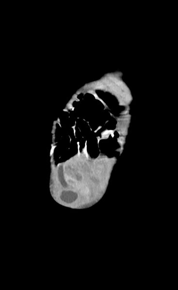 File:Abdominopelvic rhabdomyosarcoma (Radiopaedia 78356-90984 Coronal C+ portal venous phase 7).jpg
