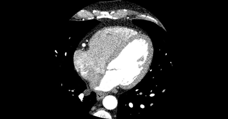 File:Aberrant left main coronary artery (ALMCA) arising from the right sinus with interarterial course (Radiopaedia 63251-71814 Axial C+ arterial phase 119).JPG