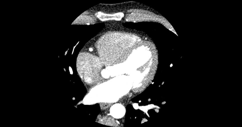 File:Aberrant left main coronary artery (ALMCA) arising from the right sinus with interarterial course (Radiopaedia 63251-71814 Axial C+ arterial phase 98).JPG