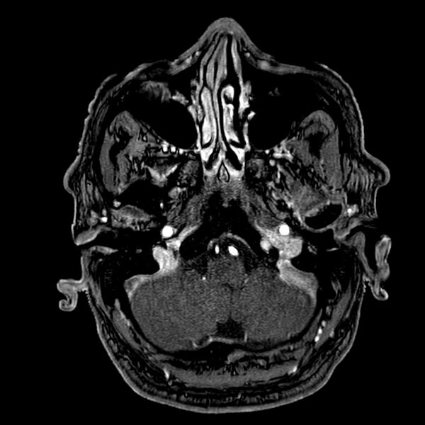 File:Accessory middle cerebral artery (Radiopaedia 73114-83828 Axial MRA 16).jpg