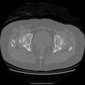 Acetabular fracture (Radiopaedia 13193-13212 Axial bone window 30).jpg