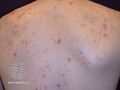 Acne affecting the back images (DermNet NZ acne-acne-back-177).jpg