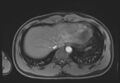 Active right ventricular cardiac sarcoidosis (Radiopaedia 55596-62100 Axial Post contrast Dixon 66).jpg