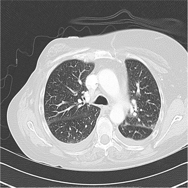 File:Acute-on-chronic pulmonary emboli (Radiopaedia 27925-28169 lung window 17).jpg