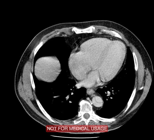 File:Acute aortic dissection - Stanford type A (Radiopaedia 40661-43285 Axial C+ portal venous phase 40).jpg