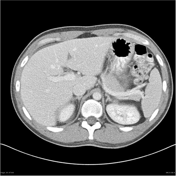 File:Acute appendicitis (Radiopaedia 25364-25615 B 11).jpg