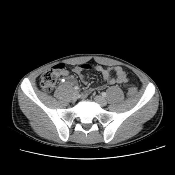 File:Acute appendicitis (Radiopaedia 27049-27227 Axial C+ portal venous phase 54).jpg