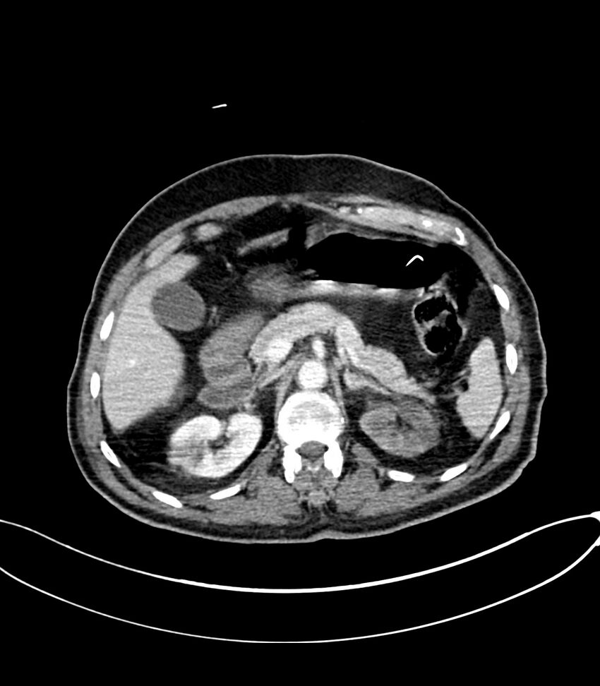 Acute arterial mesenteric ischemia (Radiopaedia 78238-90828 Axial C+ portal venous phase 45).jpg