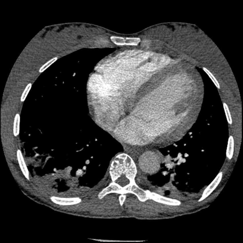 Acute chest syndrome - sickle cell disease (Radiopaedia 42375-45499 Axial C+ CTPA 129).jpg