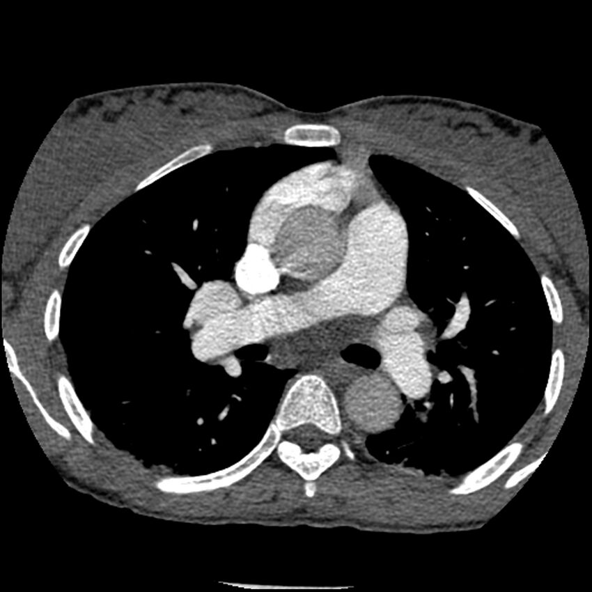 Acute chest syndrome - sickle cell disease (Radiopaedia 42375-45499 Axial C+ CTPA 83).jpg