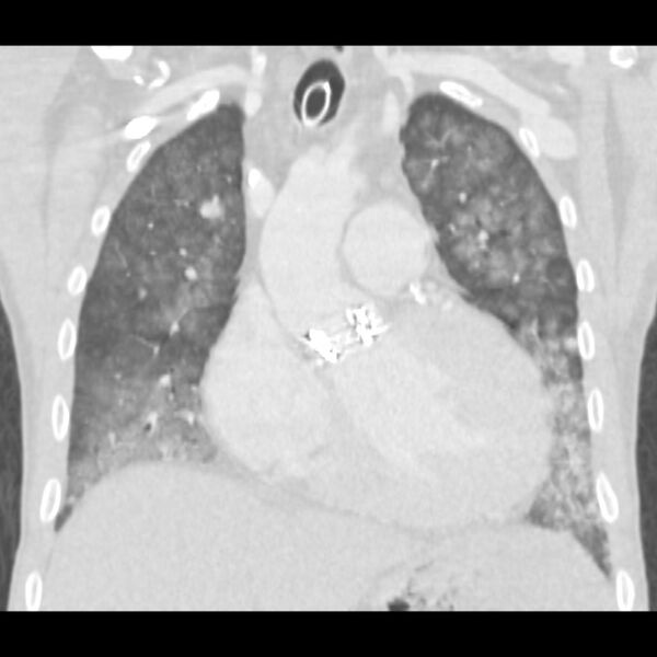 File:Acute diffuse alveolar hemorrhage (Radiopaedia 41323-44158 Coronal lung window 17).jpg