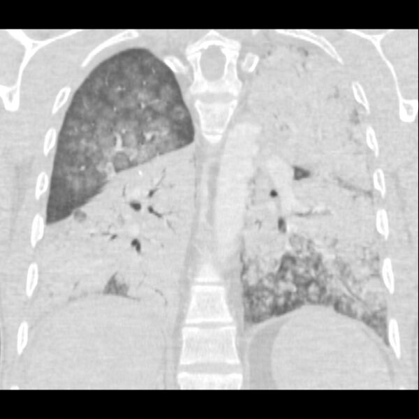 File:Acute diffuse alveolar hemorrhage (Radiopaedia 41323-44158 Coronal lung window 38).jpg