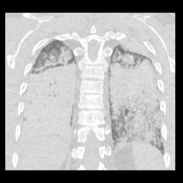 File:Acute diffuse alveolar hemorrhage (Radiopaedia 41323-44158 Coronal lung window 46).jpg