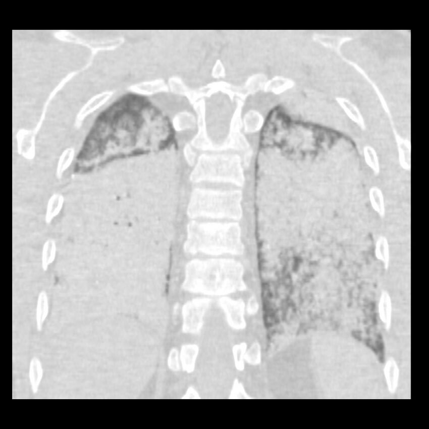 Acute diffuse alveolar hemorrhage (Radiopaedia 41323-44158 Coronal lung window 46).jpg