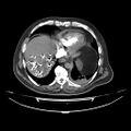 Acute heart failure (CT) (Radiopaedia 79835-93075 Axial C+ arterial phase 52).jpg