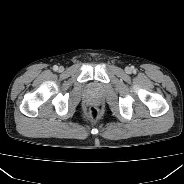 File:Acute pancreatitis (Radiopaedia 22572-22596 Axial C+ portal venous phase 74).jpg