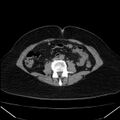 Acute pancreatitis - Balthazar C (Radiopaedia 26569-26714 Axial non-contrast 56).jpg