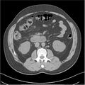Acute pancreatitis - mild (Radiopaedia 27796-28033 Axial non-contrast 24).jpg