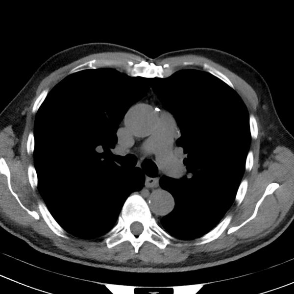 File:Acute pulmonary embolism (Radiopaedia 81677-95570 Axial non-contrast 8).jpg