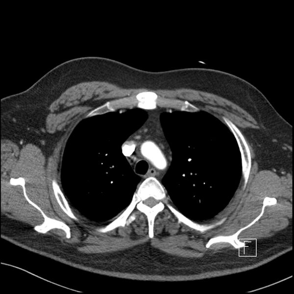 File:Acute pulmonary embolism with pulmonary infarct (Radiopaedia 73062-83768 Axial C+ CTPA 17).jpg