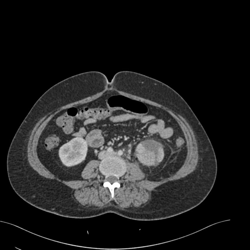 Acute pyelonephritis with renal vein thrombosis (Radiopaedia 58020-65053 Axial renal parenchymal phase 118).jpg