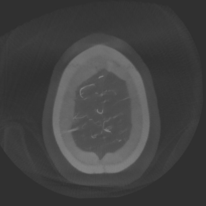 Acute subarachnoid hemorrhage and accessory anterior cerebral artery (Radiopaedia 69231-79010 Axial arterial - MIP 80).jpg