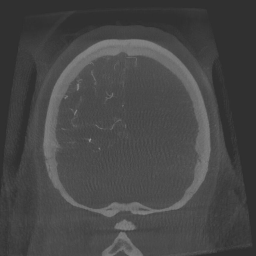 Acute subarachnoid hemorrhage and accessory anterior cerebral artery (Radiopaedia 69231-79010 Coronal arterial - MIP 87).jpg