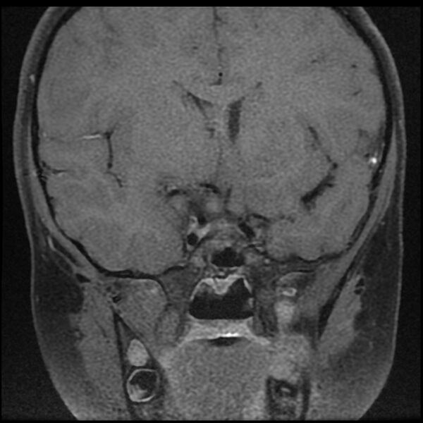 File:Adamantinomatous craniopharyngioma (Radiopaedia 77407-89529 Coronal T1 C+ fat sat 4).jpg