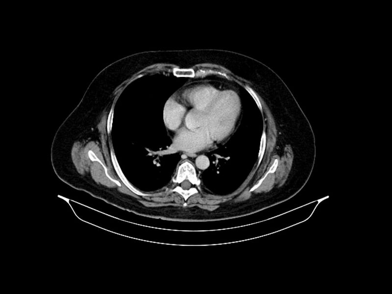 File:Adenocarcinoma of pancreas with hepatic metastasis (Radiopaedia 64332-73122 Axial C+ delayed 8).jpg