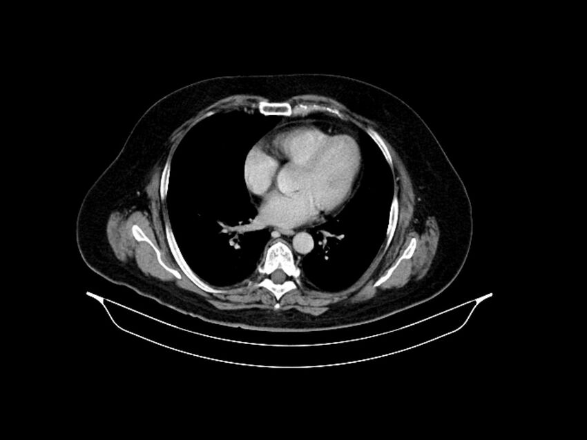 Adenocarcinoma of pancreas with hepatic metastasis (Radiopaedia 64332-73122 Axial C+ delayed 8).jpg