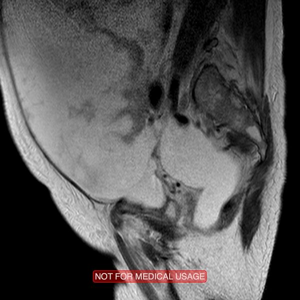 File:Adenocarcinoma of the cervix (Radiopaedia 28373-28615 Sagittal T2 2).jpg